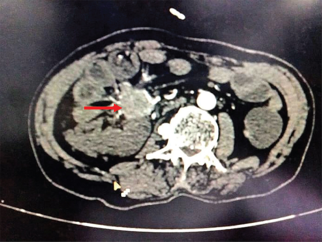 Computed tomography scan showing mass in the mesentery.